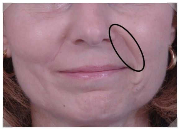 Mokdong Filler: Want to Prevent an Artificial Result? <Must Read> image 5