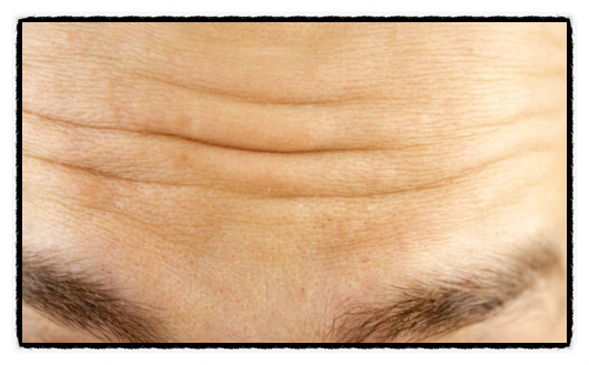 Yangcheon-gu Botox: Can Forehead Wrinkles Be Smoothly Smoothed Out? image 7