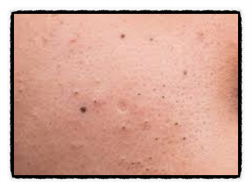 It Is Important to Properly Manage Acne in Mok-dong from the Early Stages <Written by a Doctor> image 3