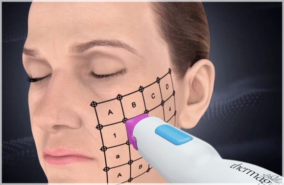 Mokdong Thermage for Elasticity and Tightening? A Detailed Effect Analysis image 2