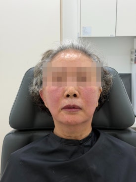 When Fillers Alone Aren’t Enough: Mokdong Thread Lifting image 11