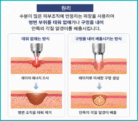 Mokdong Milia: 3 Things to Know Before Removal image 3