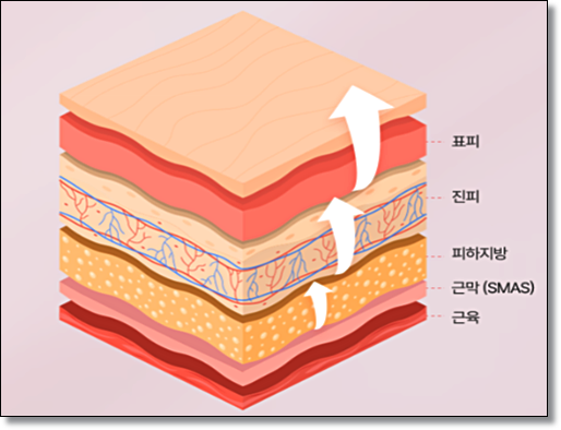 Mok-dong Lifting: What’s the Difference Between Radiofrequency and Ultrasound? image 4