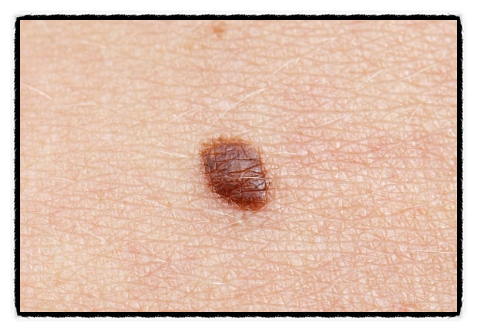 Mokdong Mole Removal: Whatever Else You Do, Be Careful About This One Thing image 2
