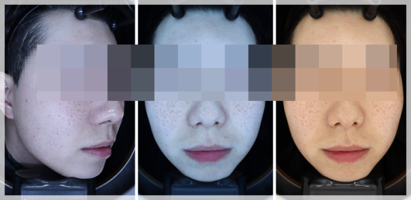 Omokgyo Dermatology Clinic, If Numerous Blemishes Make Your Skin Tone Look Dull? (Department: Dermatology) image 4