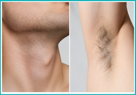 Mokdong Station Laser Hair Removal: Why Is It Also Possible for Sensitive Skin? image 7