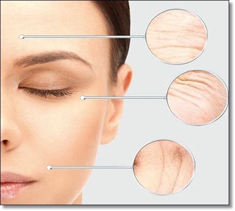 Omokgyo Filler: If wrinkles make you feel self-conscious when smiling image 5