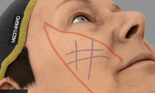 When Fillers Alone Aren’t Enough: Mokdong Thread Lifting image 4