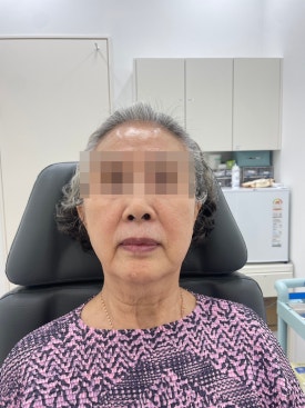 When Fillers Alone Aren’t Enough: Mokdong Thread Lifting image 8