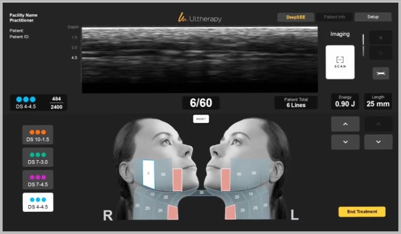 Why Is Ulthera Designated as the “Gold Standard”? Let’s Look at the Research image 5