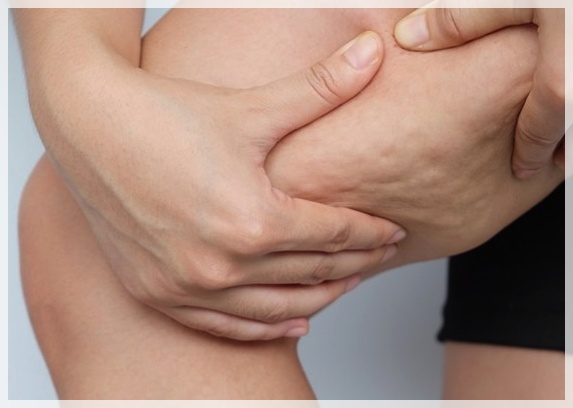 I Lost Weight, So Why Is the Cellulite Still There? <Why InMode BodyFX Is Needed> image 1