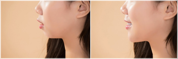 If You’re Looking for a Way to Enhance the Jawline with Mokdong Filler image 3