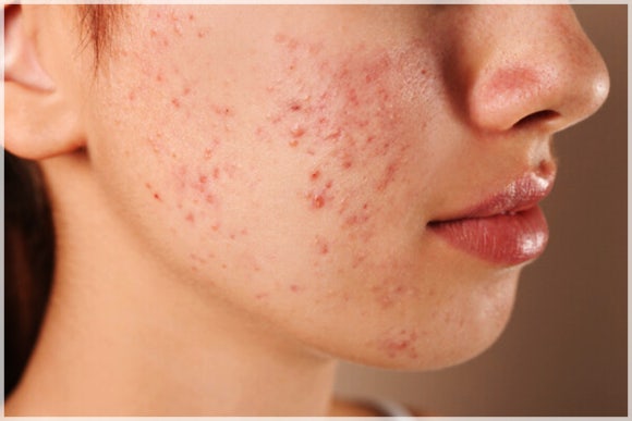 If You Want to Treat Acne and Syringomas with Mokdong Agnes image 2