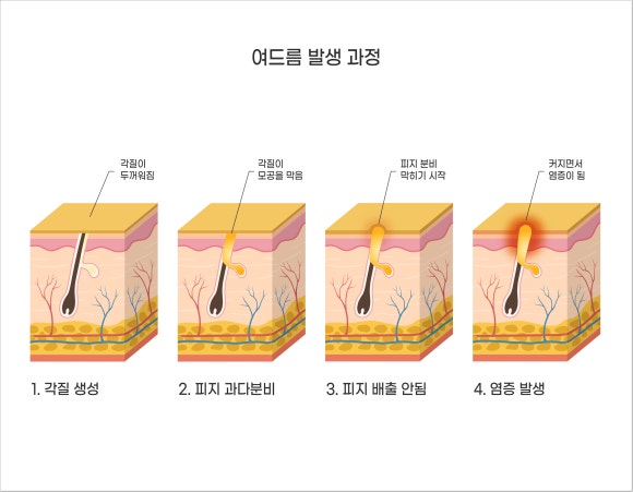 Yangcheon-gu Acne Treatment: If You’re Tired of Repeated Breakouts, Read This. image 2