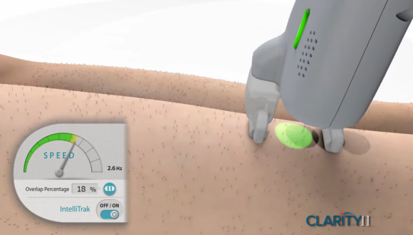 Why This Is Important for Mok-dong Laser Hair Removal image 4