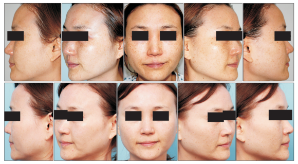 Did Mokdong Pico Toning Not Work for You? The Papers Say It Should Be Done Like This image 4