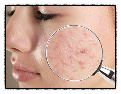 Seoul Blemish Removal: You Shouldn’t Focus Only on Pigment image 4