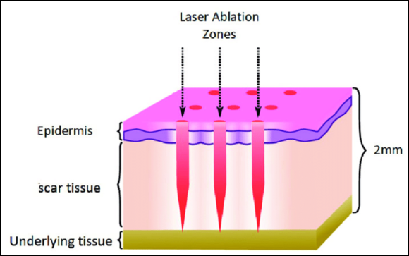 Mokdong Fraxel: Reviewing the Effects on Enlarged Pores and Acne Scars Through Research Papers image 2