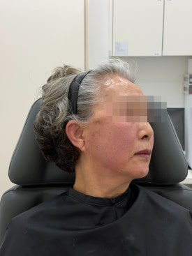 When Fillers Alone Aren’t Enough: Mokdong Thread Lifting image 9