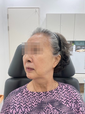 When Fillers Alone Aren’t Enough: Mokdong Thread Lifting image 6