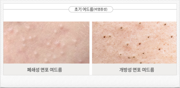 양천구여드름 흉터 남기 전에 신속하게 대응해야 하는 이유 <의사 작성> 관련 이미지 3