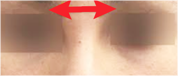 When Fillers Alone Aren’t Enough: Mokdong Thread Lifting image 3