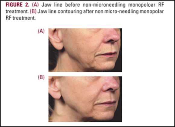 If You’re Looking for Thermage Without Sedation in Mok-dong image 5