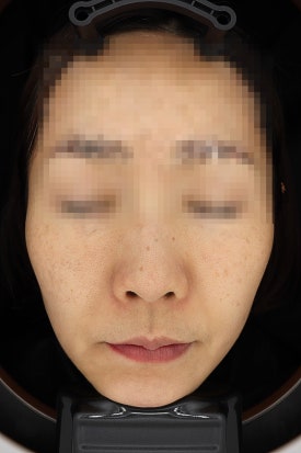 목동 레이저토닝 기미 주근깨 치료 제대로 하려면 관련 이미지 7