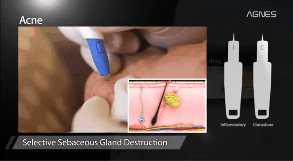 If You Want to Treat Acne and Syringomas with Mokdong Agnes image 7