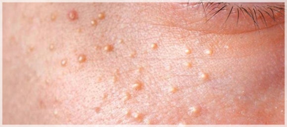 If You Want to Treat Acne and Syringomas with Mokdong Agnes image 3