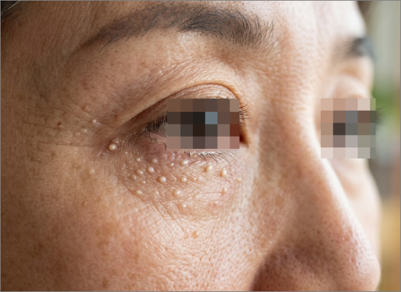 Mokdong Milia: 3 Things to Know Before Removal image 1