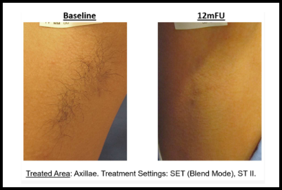 Why Does Mokdong Laser Hair Removal Require Multiple Sessions? image 5