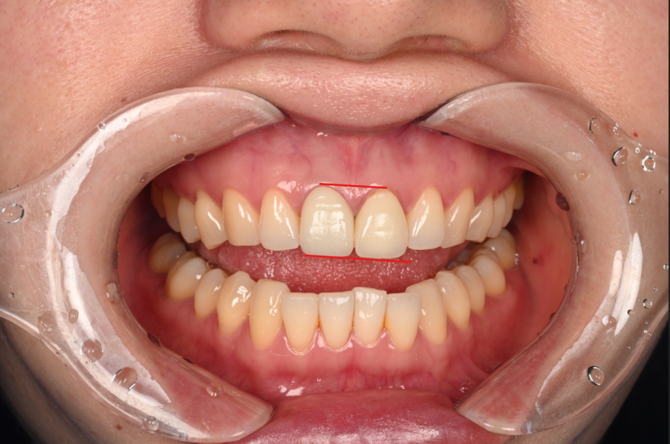 Songpa-dong Dentist: It Wasn’t Just the Front Crown That Was Replaced! A retreatment case that also considered the gum line image 3