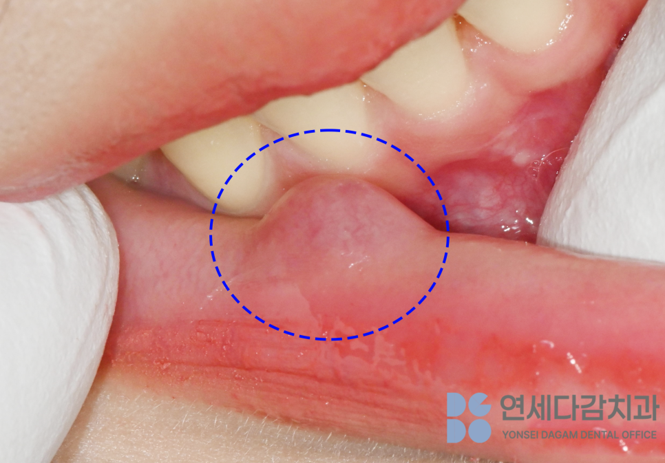 입안에 혹이 느껴진다면 외상성 섬유종 의심해 볼 수 있습니다 개롱역 치과 에서 알려드리는 원인과 치료방법 관련 이미지 2