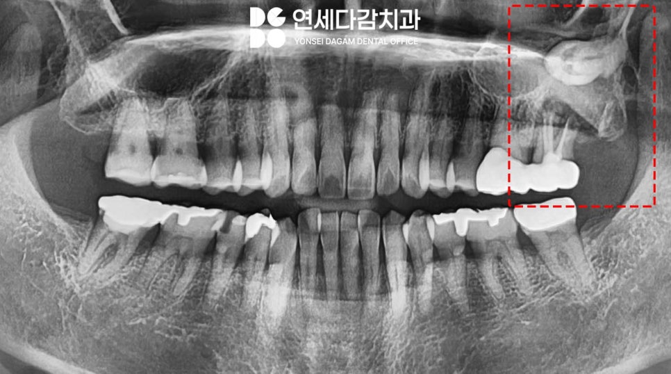 심한 염증으로 특이한 곳에 위치한 매복 사랑니 송파역 치과 에서 임플란트 수술과 함께 안전한 발치 했습니다. (feat. 상악동 천공 폐쇄술 ) 관련 이미지 1