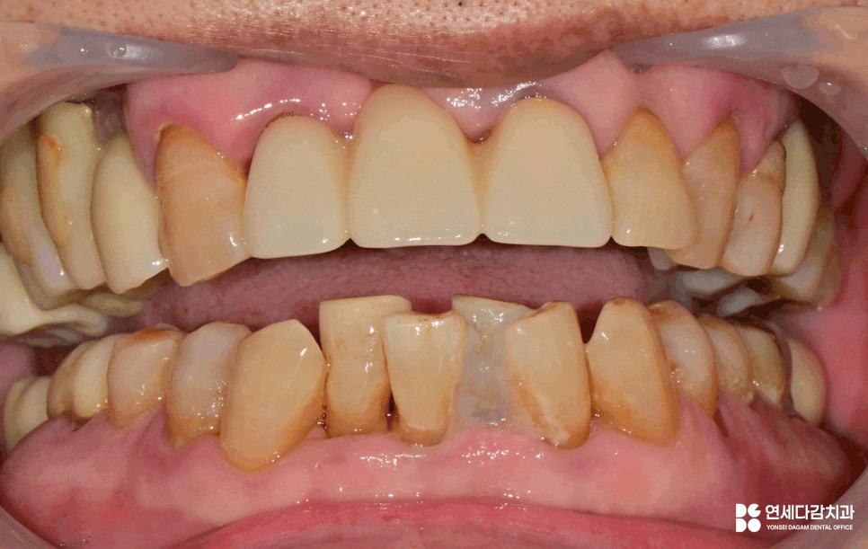 치주염으로 인한 앞니 탈구, 개롱역 치과 에서 설명하는 잠간 고정술 이야기 관련 이미지 4