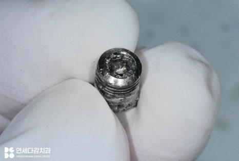 어금니 찌릿한 통증 치아에 금갔을때 신경치료 크라운 가락시장역 치과 충치 깊을 때 당일 발치 임플란트 및 부러진 보철 임플란트재식립 관련 이미지 9