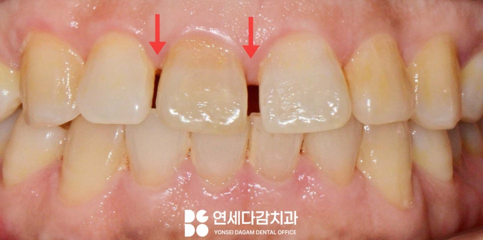 송파동 치과 앞니 사이 벌어짐 라미네이트 부분적으로 가능할까? 관련 이미지 2