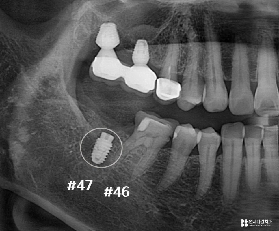 개롱역치과 아프기 전에 발견해야 되는 이유 인접면 충치 치료 관련 이미지 5
