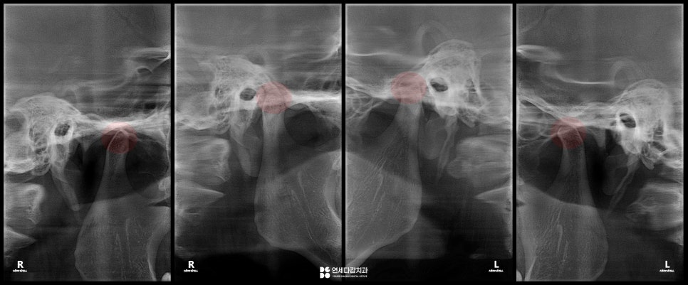 입 벌릴 때 불편하다면? 이갈이로 인한 통증 턱관절 증상 보톡스가 필요한 이유 가락동 치과 관련 이미지 4