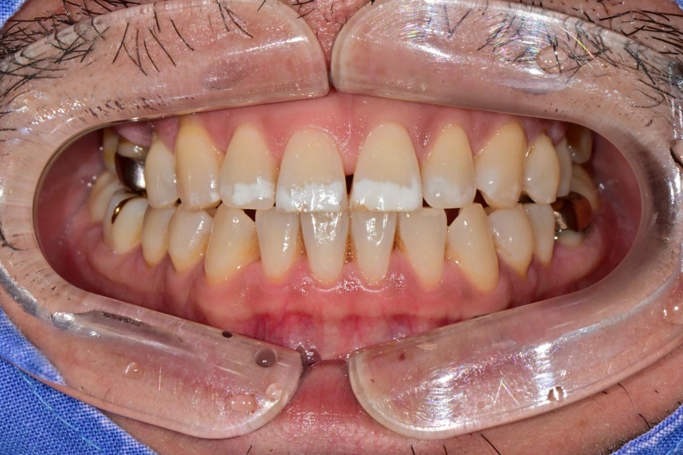Ogeum-dong Dentist: Want to Improve Front-Tooth Discoloration and Black Triangles at Once with Veneers? <Must-Read> image 2