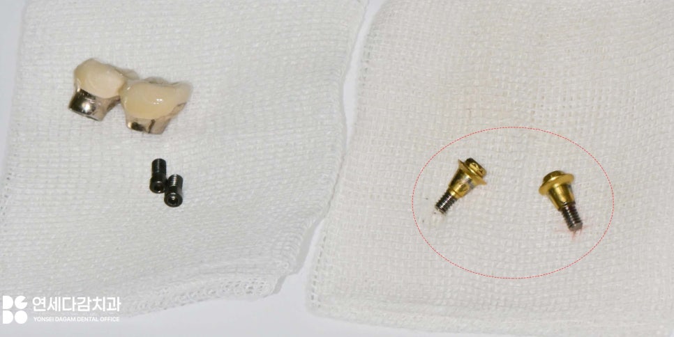 오래된 임플란트 다시 수술하지 않고 크라운 교체만 가능할까 문정동 치과 SCRP 타입으로 보철 재제작 관련 이미지 7