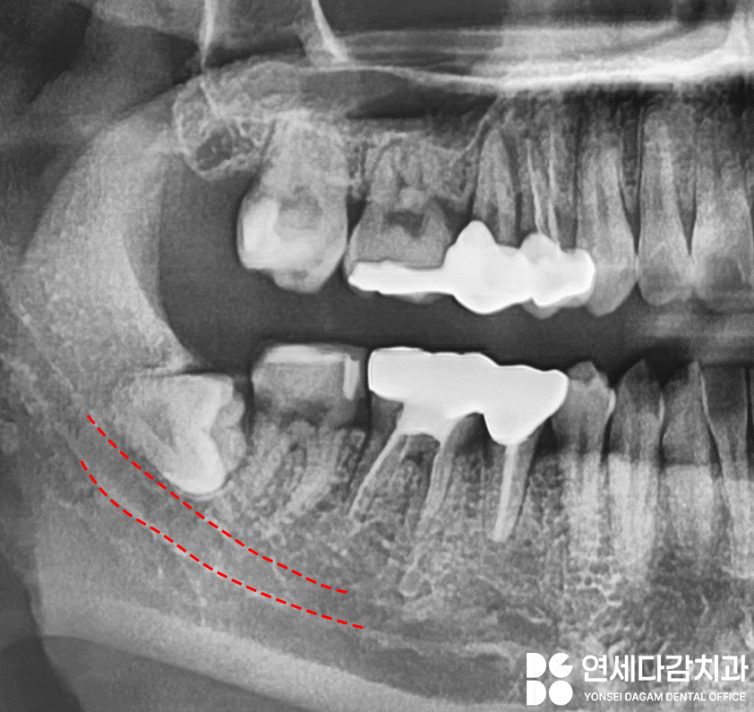 복잡한 매복 사랑니 발치 오금동 치과 에서 CT 촬영을 통한 분석 과정 관련 이미지 5