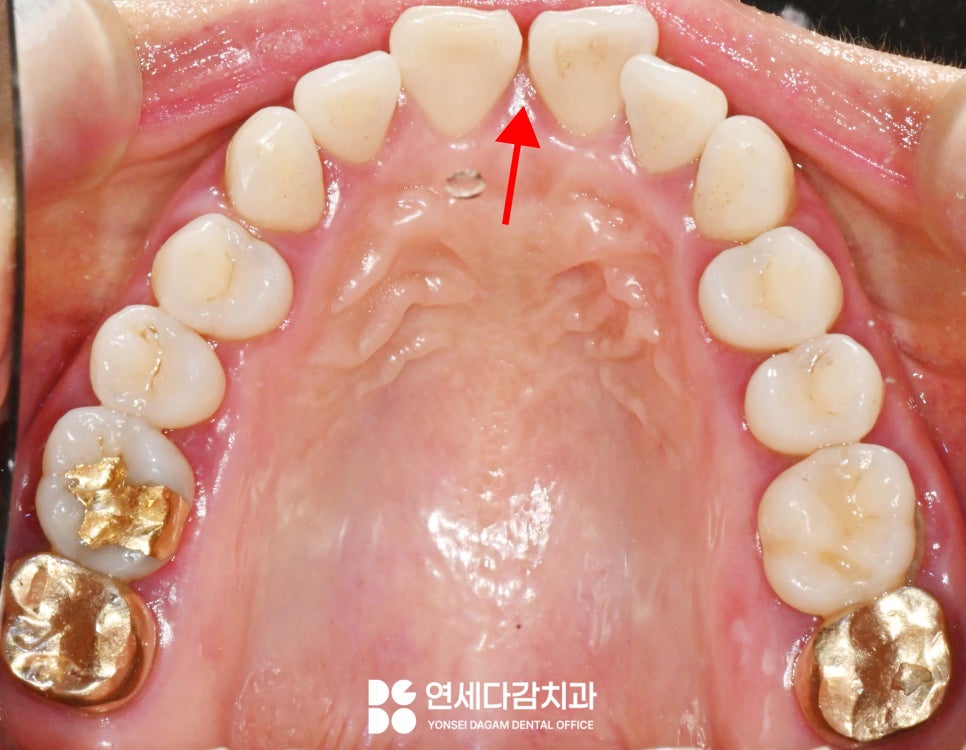 앞니 사이 벌어짐, 틈(치간이개) 문정역 치과 에서 선택하는 치료 방법 관련 이미지 3