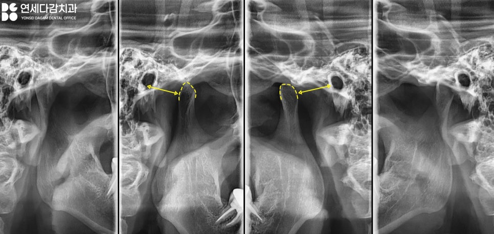 턱관절 통증 송파동 치과 에서 원인 찾고 해결 과정 살펴봅시다.(feat. 초음파 물리치료 및 보톡스 ) 관련 이미지 3
