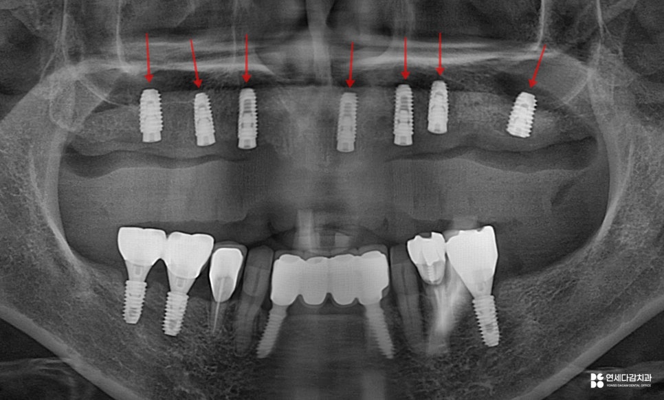 개롱역 치과 치주 질환으로 인한 심한 잇몸뼈 손실 - 네비게이션 방식 임플란트로 진행된 안전한 치료 관련 이미지 11