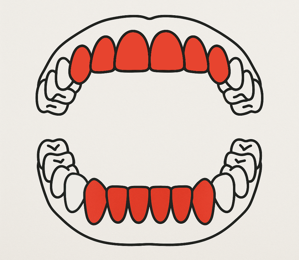 송파동 치과 앞니 사이 벌어짐 라미네이트 부분적으로 가능할까? 관련 이미지 1