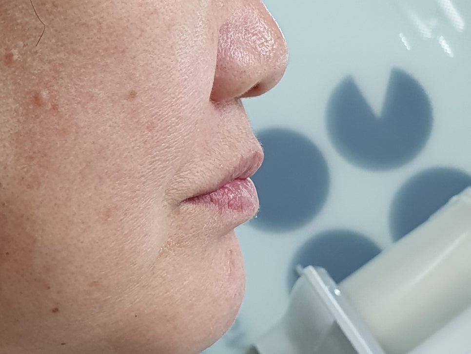 Prosthetics After Implants in Ogeum-dong: Occlusion and Facial Balance Matter Too image 7