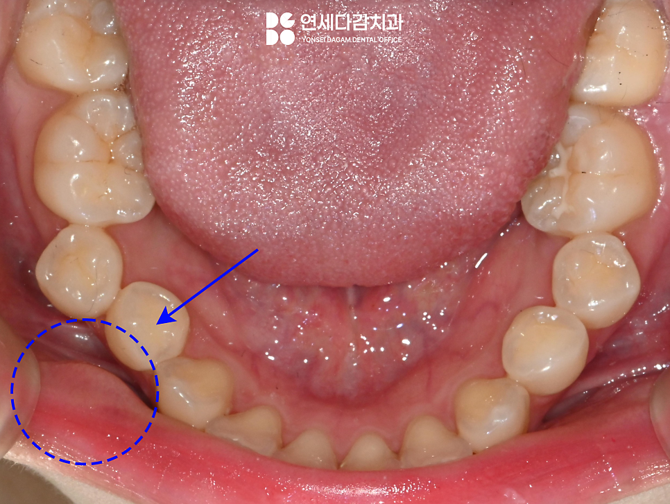 입안에 혹이 느껴진다면 외상성 섬유종 의심해 볼 수 있습니다 개롱역 치과 에서 알려드리는 원인과 치료방법 관련 이미지 1