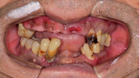 Temporary Teeth After Implants in Songpa-dong: Why They Can Be Provided Quickly image 3
